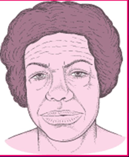 Facies acromegalica