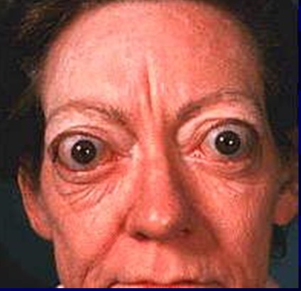 Facies basedowiana