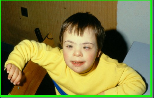 Bambino con sindrome di Down