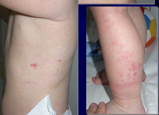 Sindrome di Goltz: lesioni