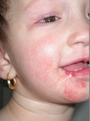 Sindrome di Goltz: volto