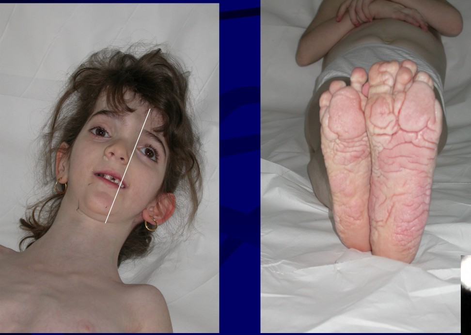 Sindrome di Proteus
