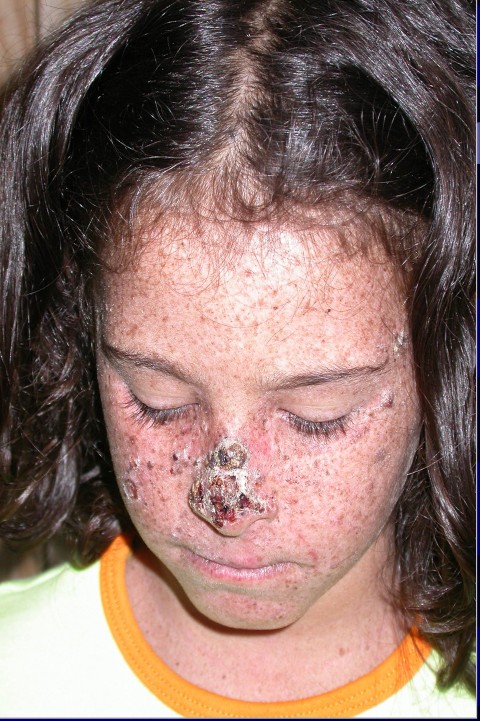 Xeroderma pigmentoso